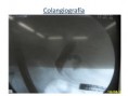 /album/ubicacion-aberrante-de-papila/asenda-papila-bulboduodenal-1-5-jpg/